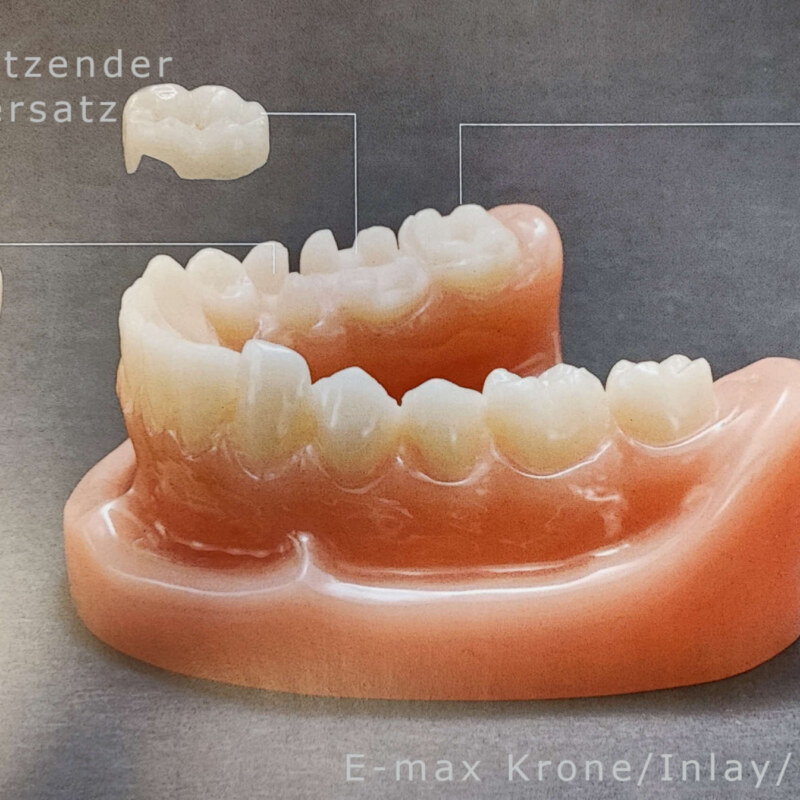 Emax Krone Inlay OnlayHoch