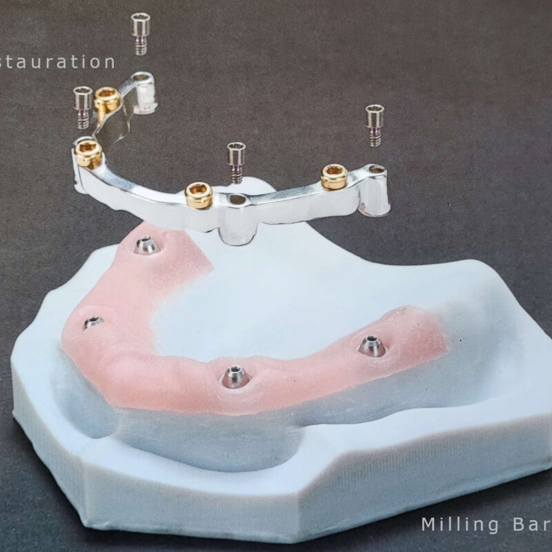 Implantat milling bar