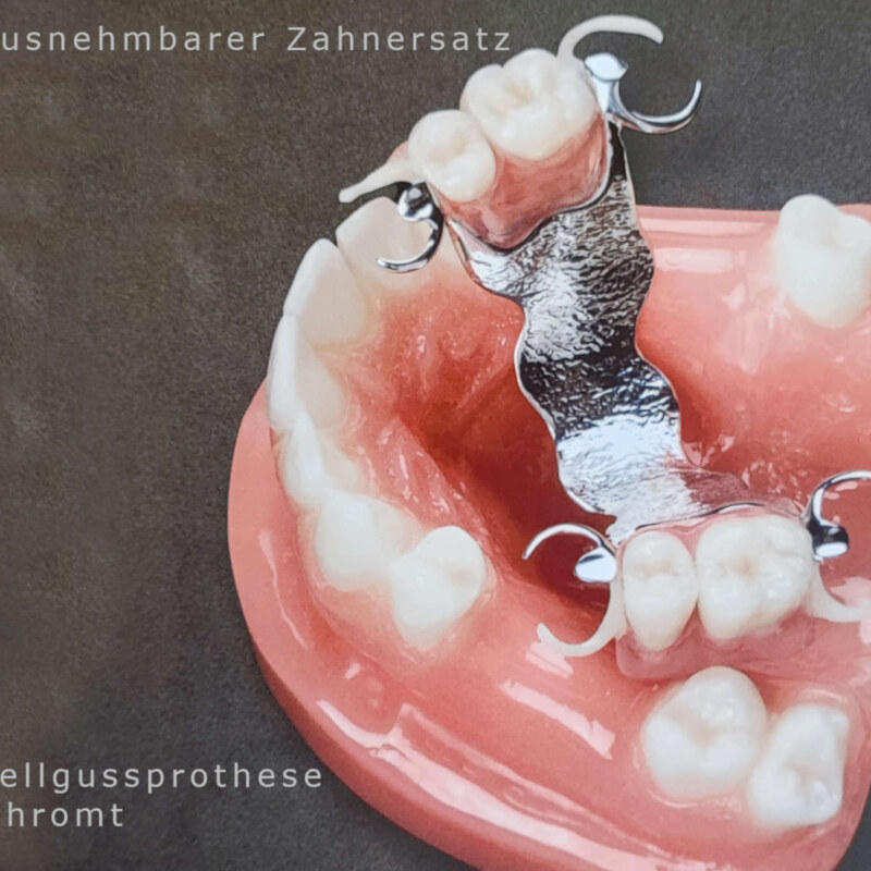 Modellgussprothese hoch