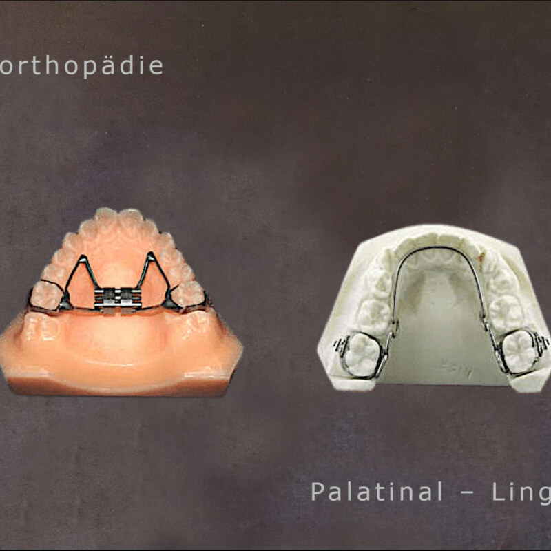 Palatinal-lingualbogen