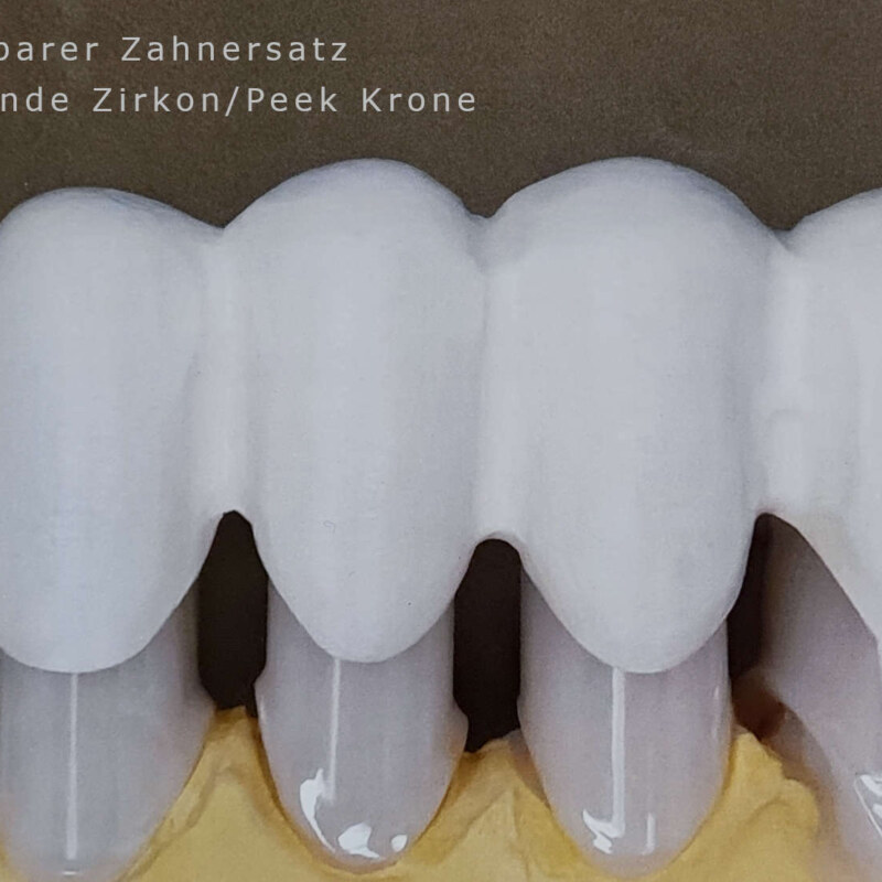Teleskopierende Zirkon Peek Krone