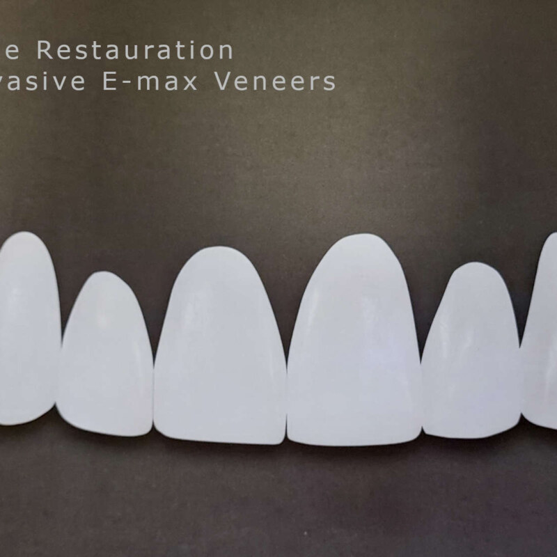 emax veener