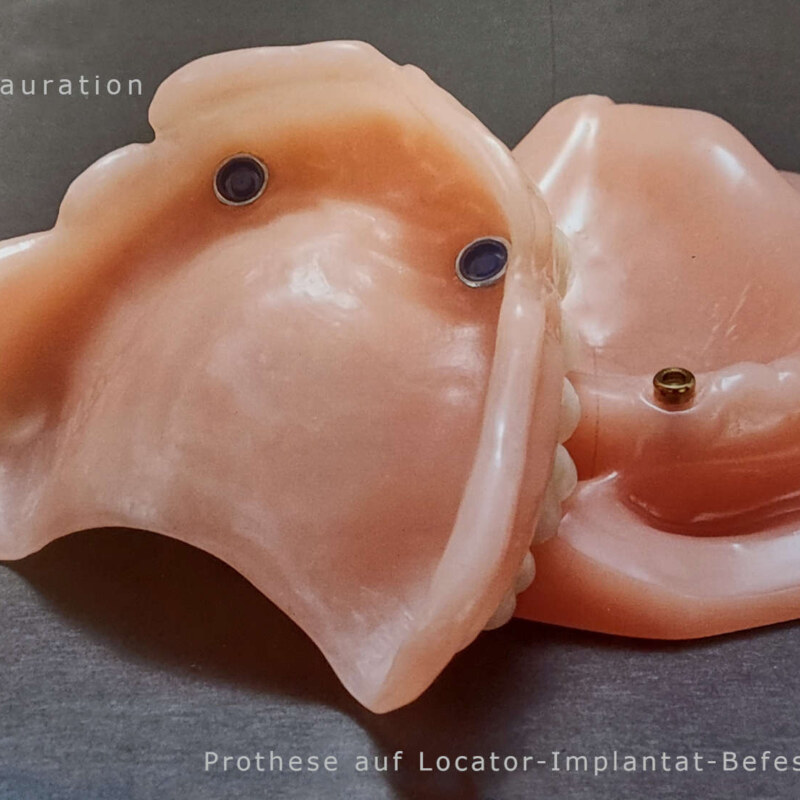implantat resaturation locator