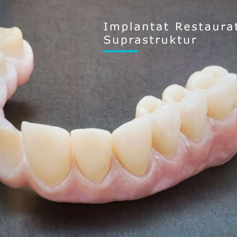Implant Suprastruktur